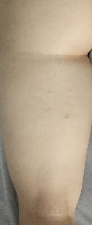 lipedema